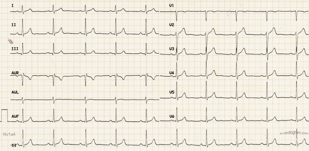 ECG live
